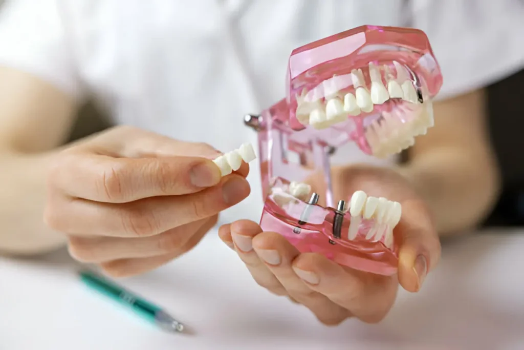 Profissional a segurar molde de dentes a demonstrar como funciona o implante dentário